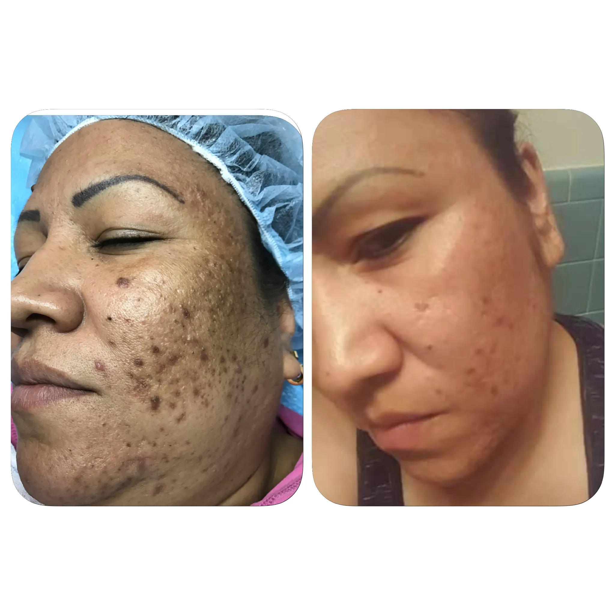 Rena Levi’s Deep Herbal Peel Kit   (PRO)