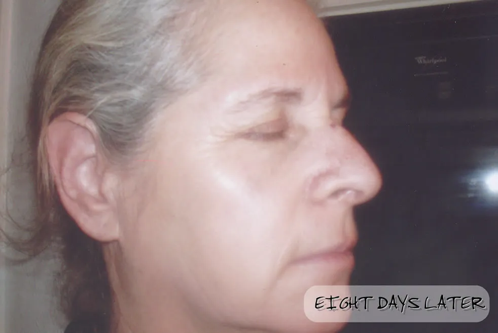 Rena Levi’s Deep Herbal Peel Kit   (PRO)