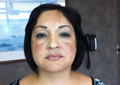 Rena Levi’s Deep Herbal Peel Kit   (PRO)